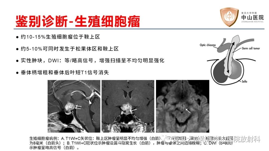 【病例】颅咽管瘤2例CT及MR影像-21