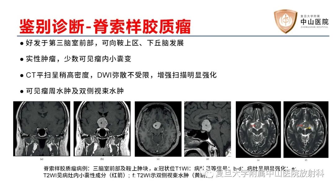 【病例】颅咽管瘤2例CT及MR影像-22