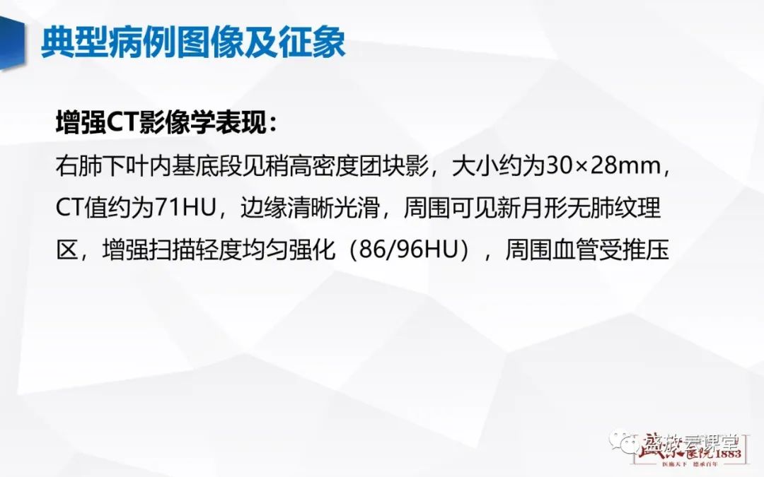 【病例】硬化性肺细胞瘤1例CT影像-4