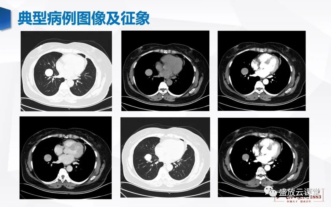 【病例】硬化性肺细胞瘤1例CT影像-3