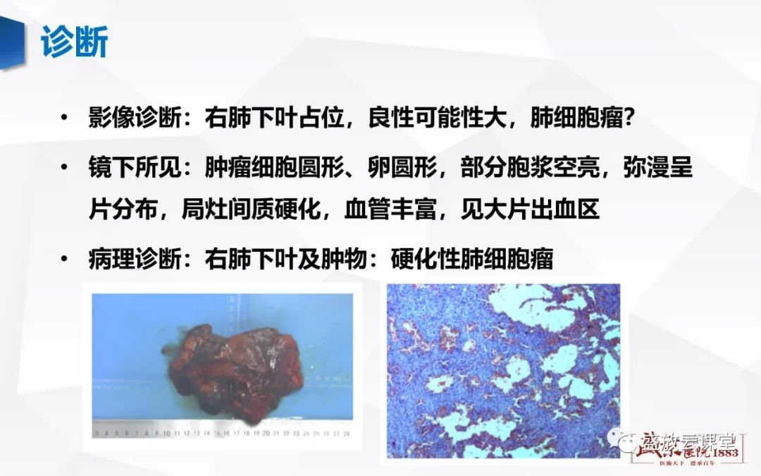 【病例】硬化性肺细胞瘤1例CT影像-7