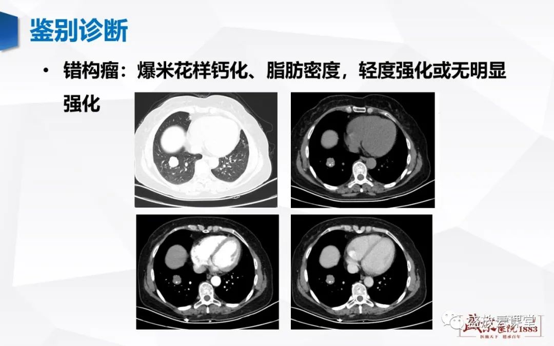 【病例】硬化性肺细胞瘤1例CT影像-9