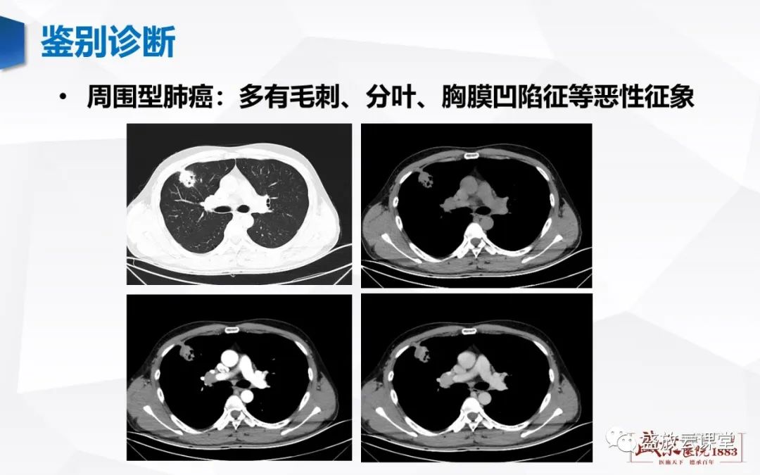 【病例】硬化性肺细胞瘤1例CT影像-8