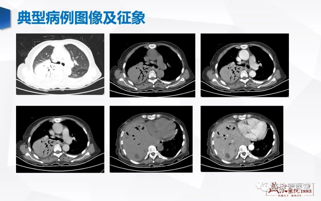 【病例】肺淋巴瘤(MALT)一例CT影像-2