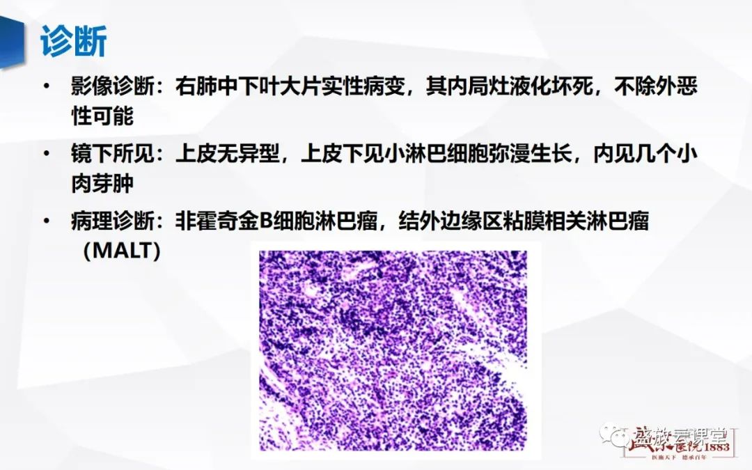 【病例】肺淋巴瘤(MALT)一例CT影像-6