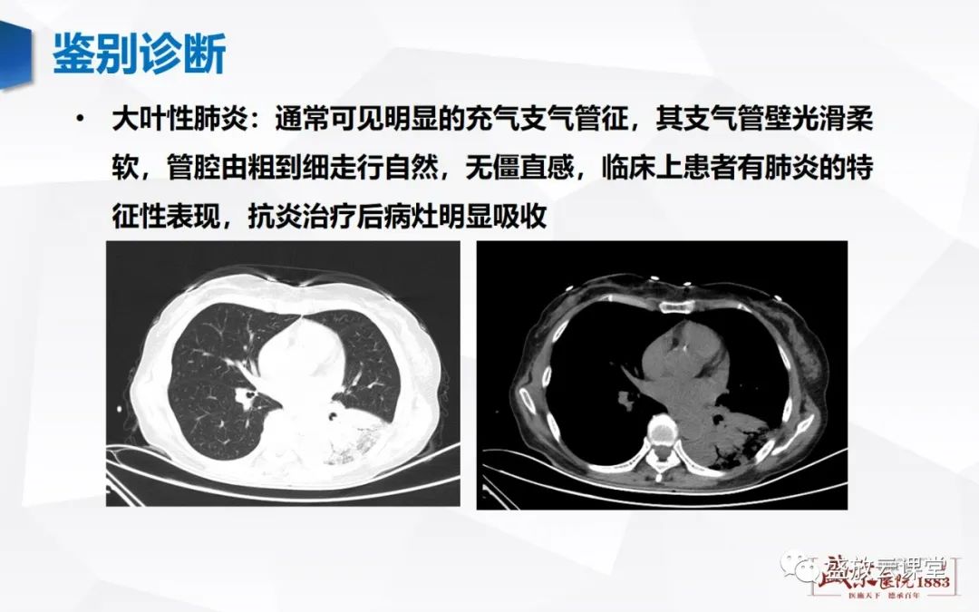 【病例】肺淋巴瘤(MALT)一例CT影像-7