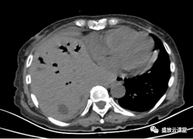 【病例】肺淋巴瘤(MALT)一例CT影像-5