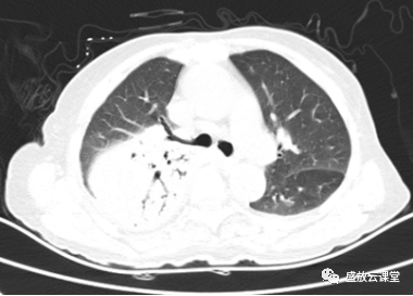 【病例】肺淋巴瘤(MALT)一例CT影像-1