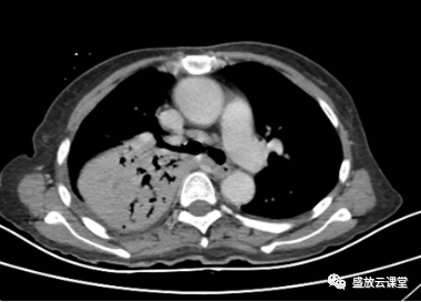 【病例】肺淋巴瘤(MALT)一例CT影像-4