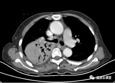 【病例】肺淋巴瘤(MALT)一例CT影像-3
