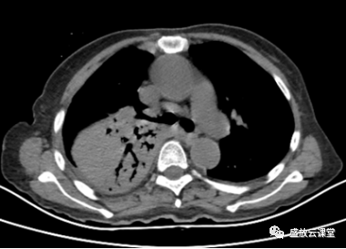 【病例】肺淋巴瘤(MALT)一例CT影像-2