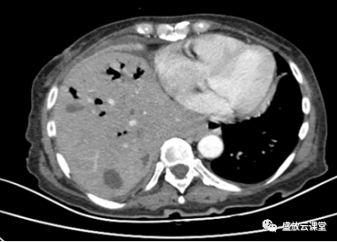 【病例】肺淋巴瘤(MALT)一例CT影像-6