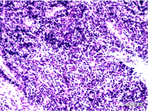 【病例】肺淋巴瘤(MALT)一例CT影像-7