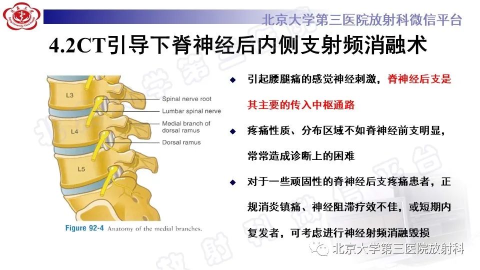 【PPT】CT引导下介入技术在脊柱退行性疾病诊疗中的应用-28