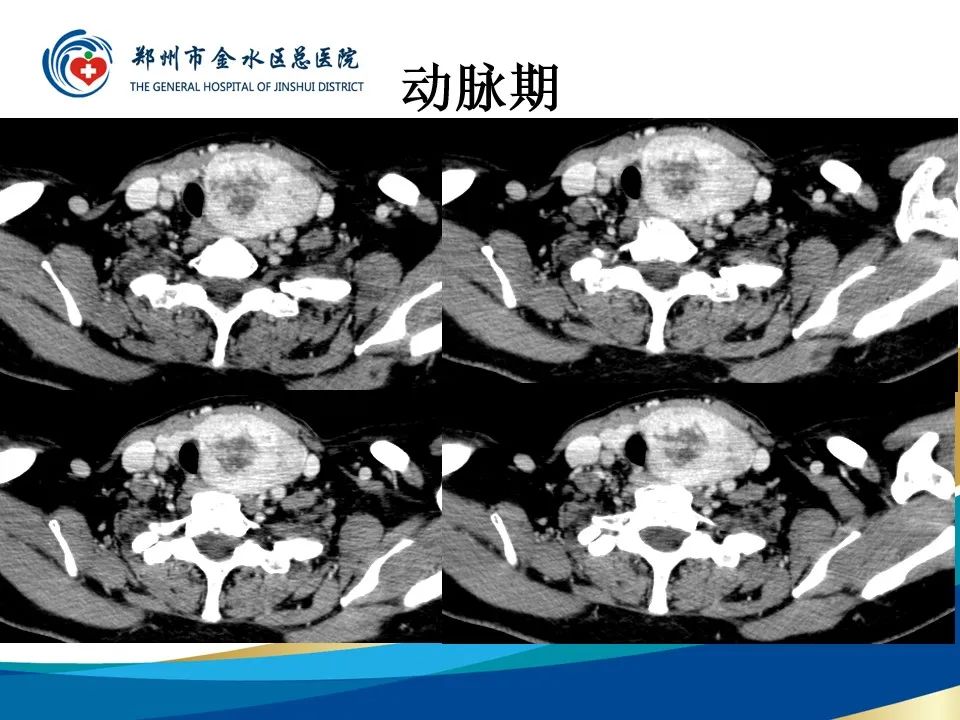 【PPT】甲状腺常见相关疾病的影像诊断-8