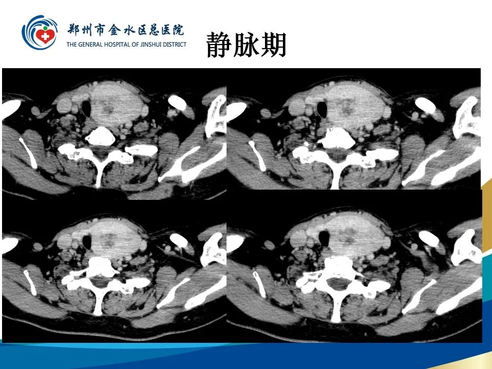 【PPT】甲状腺常见相关疾病的影像诊断-10