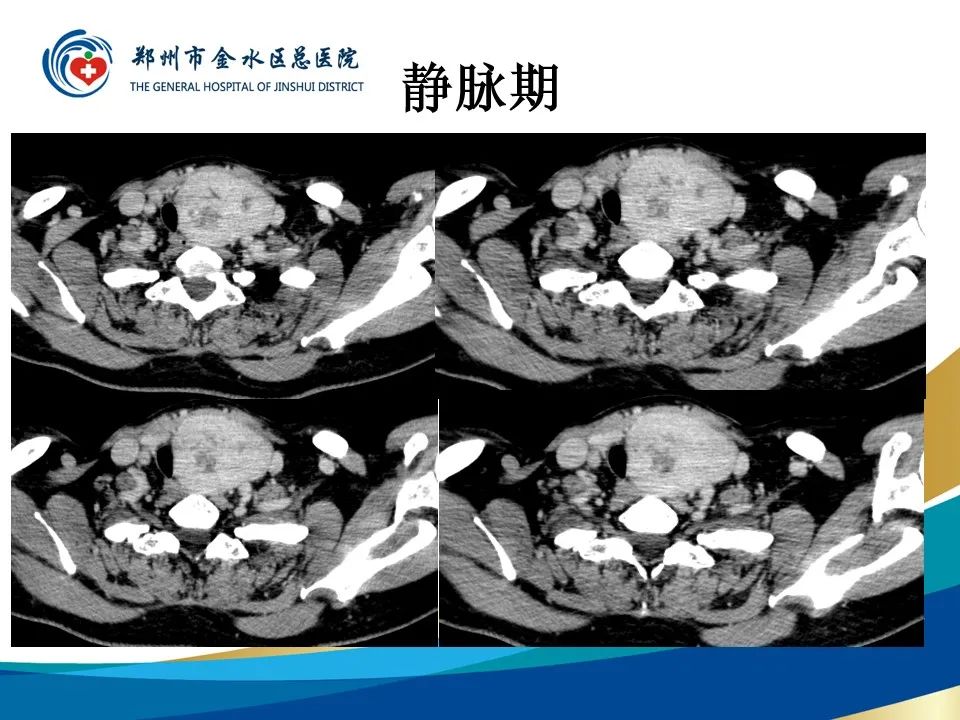 【PPT】甲状腺常见相关疾病的影像诊断-9