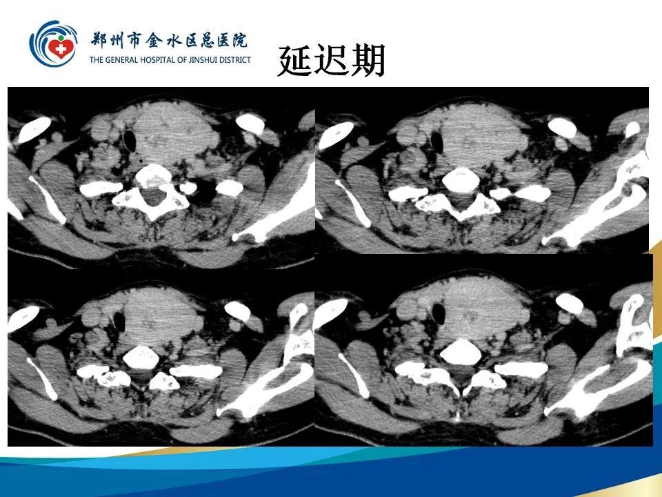【PPT】甲状腺常见相关疾病的影像诊断-11