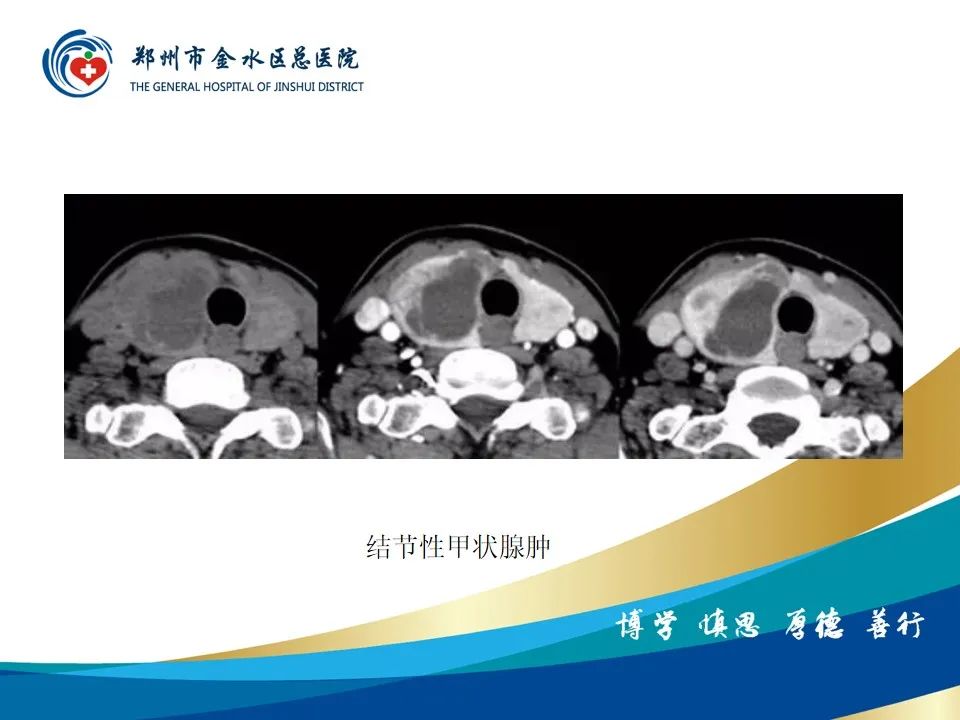 【PPT】甲状腺常见相关疾病的影像诊断-25