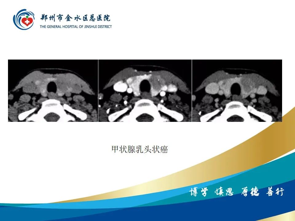 【PPT】甲状腺常见相关疾病的影像诊断-29