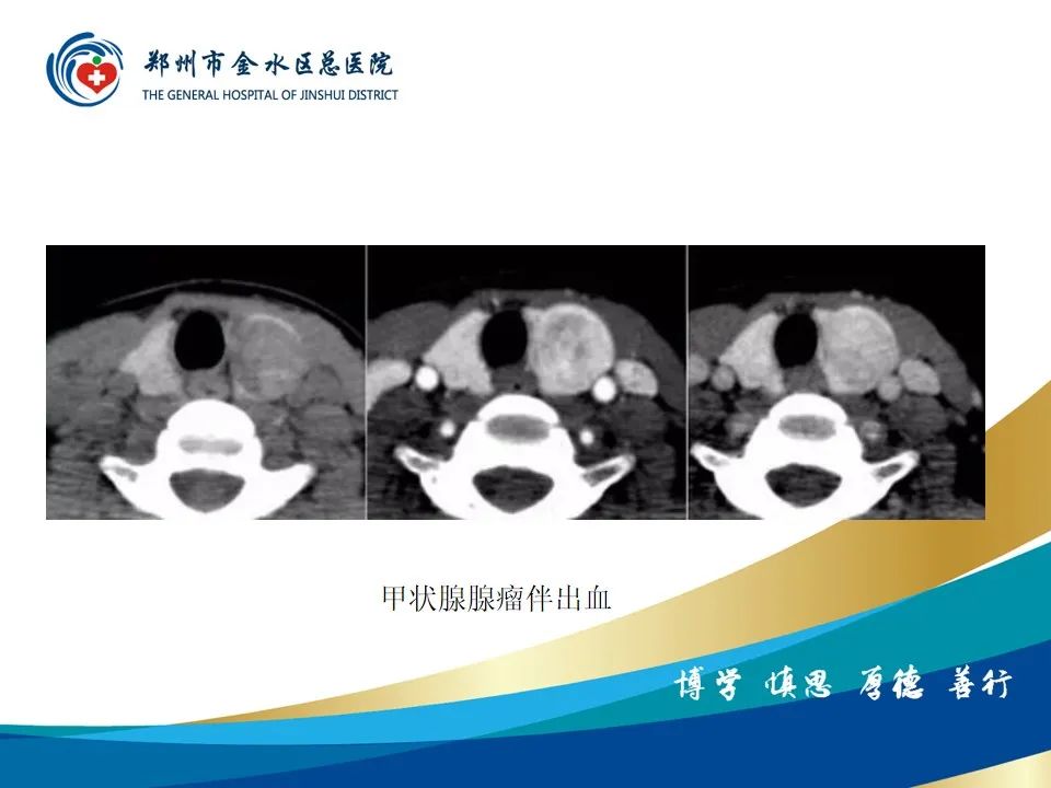 【PPT】甲状腺常见相关疾病的影像诊断-27