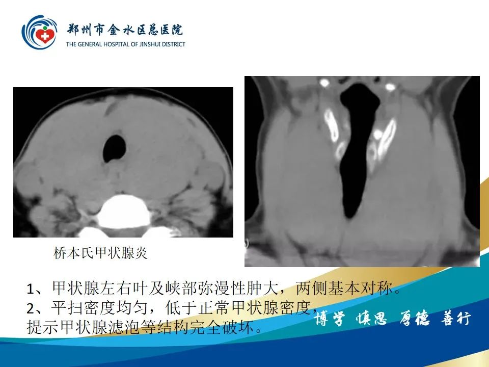 【PPT】甲状腺常见相关疾病的影像诊断-32