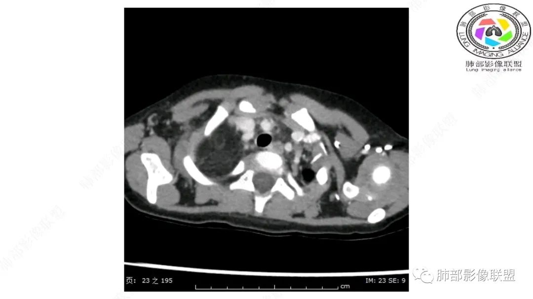 【病例】幼儿脂肪母细胞瘤1例CT影像-5