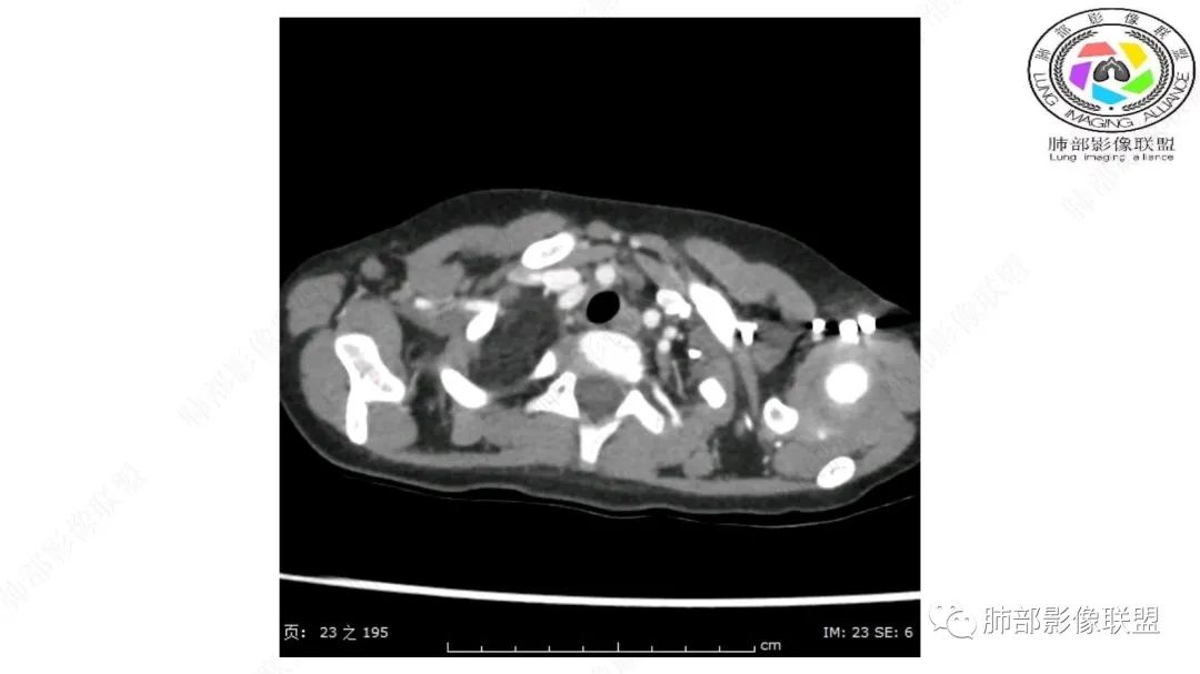 【病例】幼儿脂肪母细胞瘤1例CT影像-4