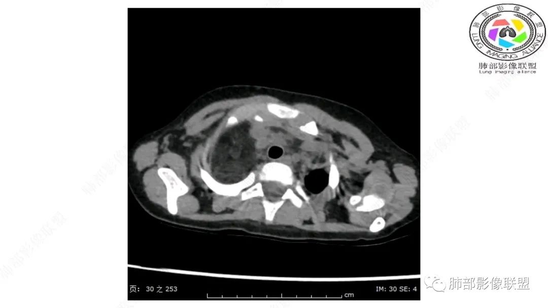 【病例】幼儿脂肪母细胞瘤1例CT影像-3