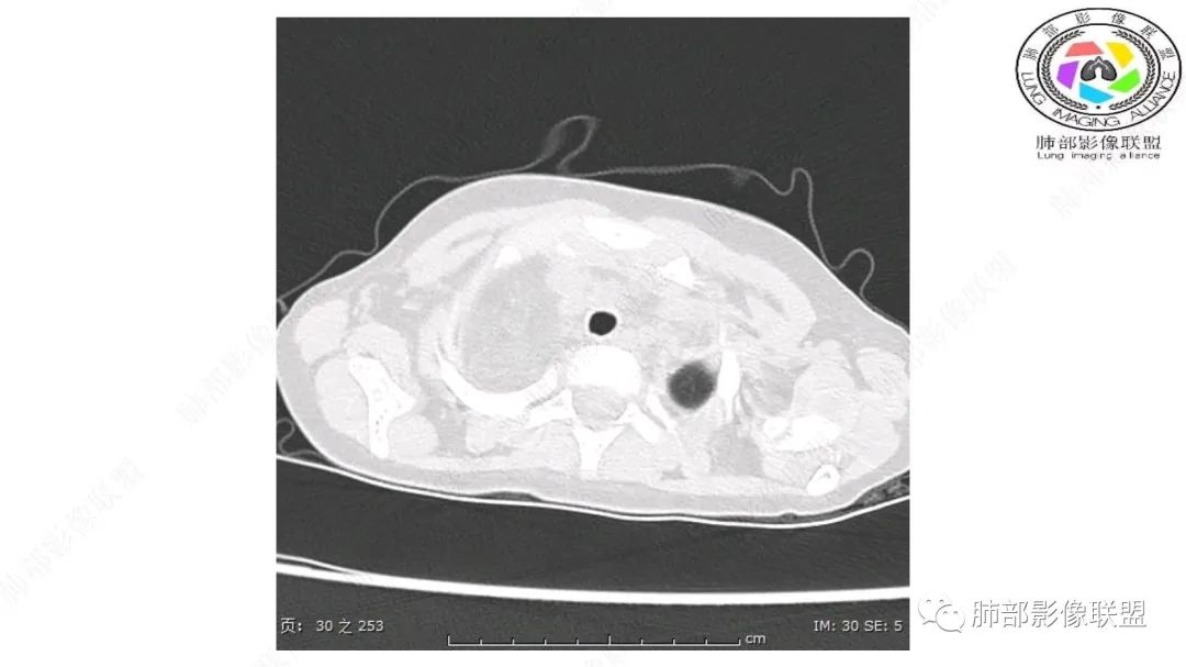 【病例】幼儿脂肪母细胞瘤1例CT影像-6