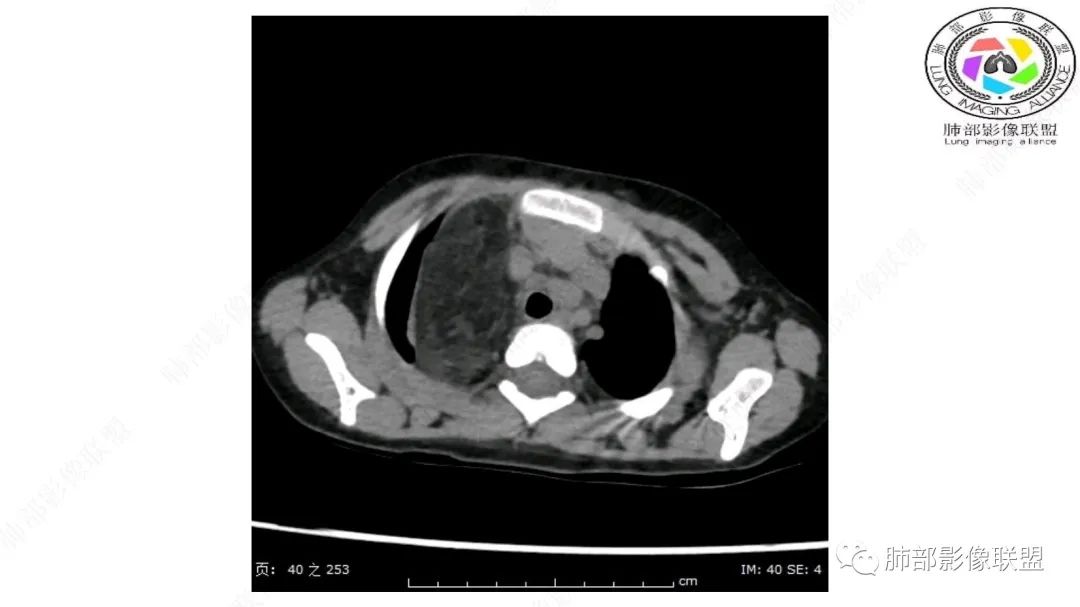 【病例】幼儿脂肪母细胞瘤1例CT影像-7