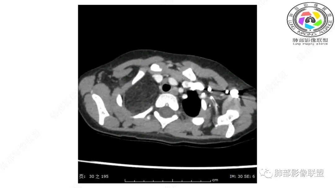 【病例】幼儿脂肪母细胞瘤1例CT影像-8