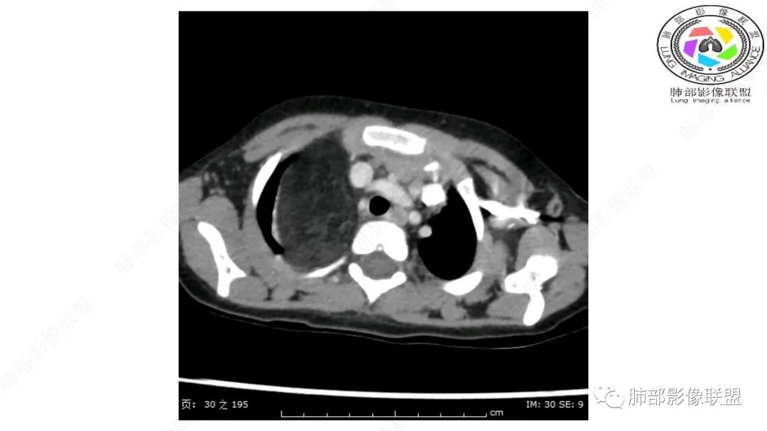【病例】幼儿脂肪母细胞瘤1例CT影像-9