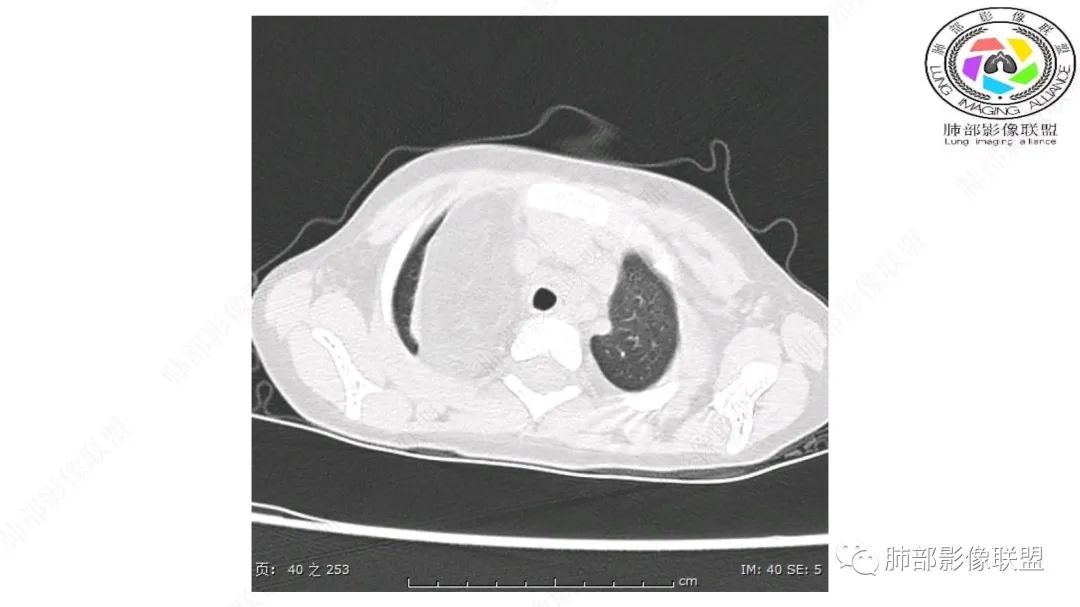 【病例】幼儿脂肪母细胞瘤1例CT影像-10