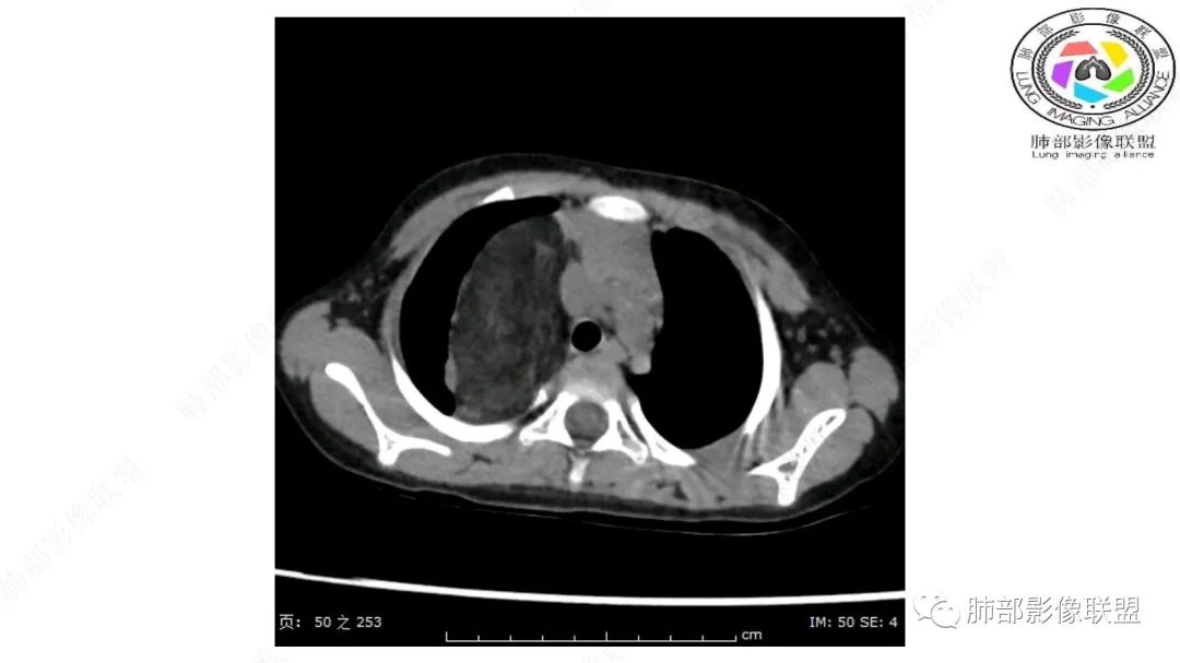 【病例】幼儿脂肪母细胞瘤1例CT影像-11