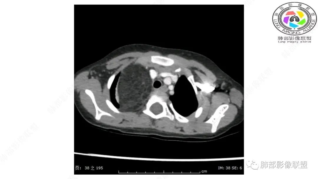 【病例】幼儿脂肪母细胞瘤1例CT影像-12