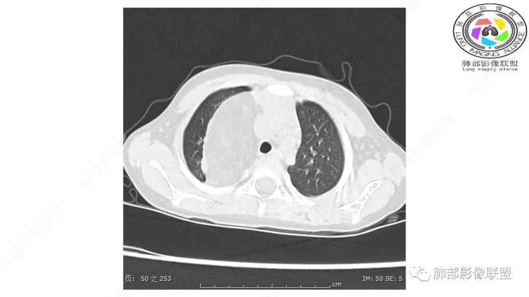 【病例】幼儿脂肪母细胞瘤1例CT影像-13