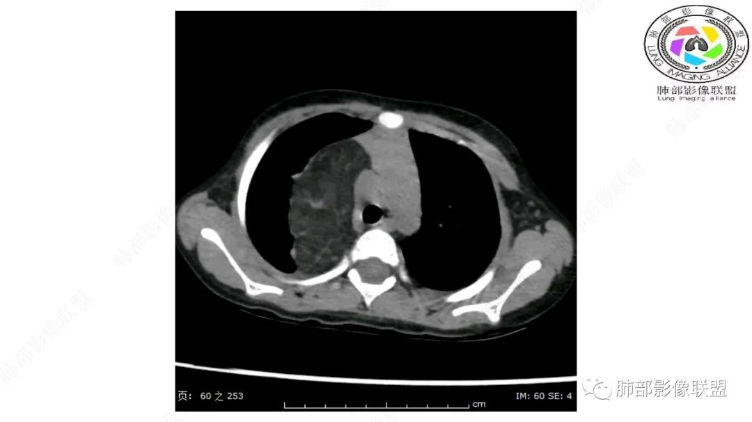 【病例】幼儿脂肪母细胞瘤1例CT影像-14