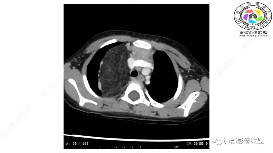 【病例】幼儿脂肪母细胞瘤1例CT影像-15