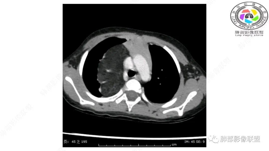 【病例】幼儿脂肪母细胞瘤1例CT影像-16