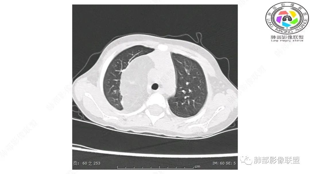 【病例】幼儿脂肪母细胞瘤1例CT影像-17