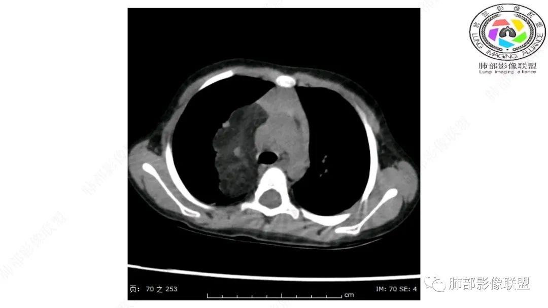 【病例】幼儿脂肪母细胞瘤1例CT影像-18