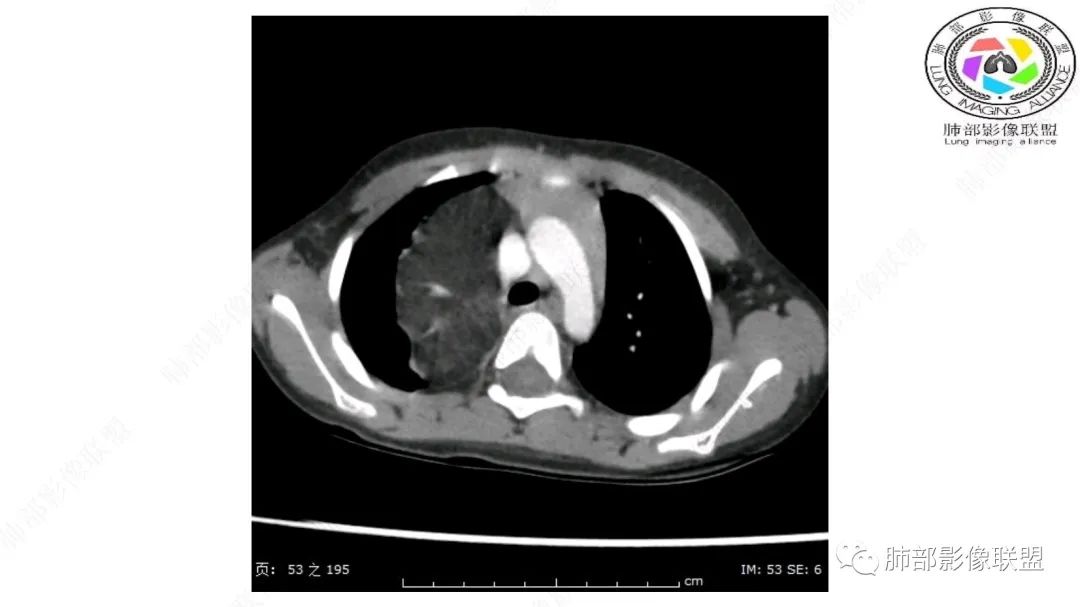 【病例】幼儿脂肪母细胞瘤1例CT影像-19