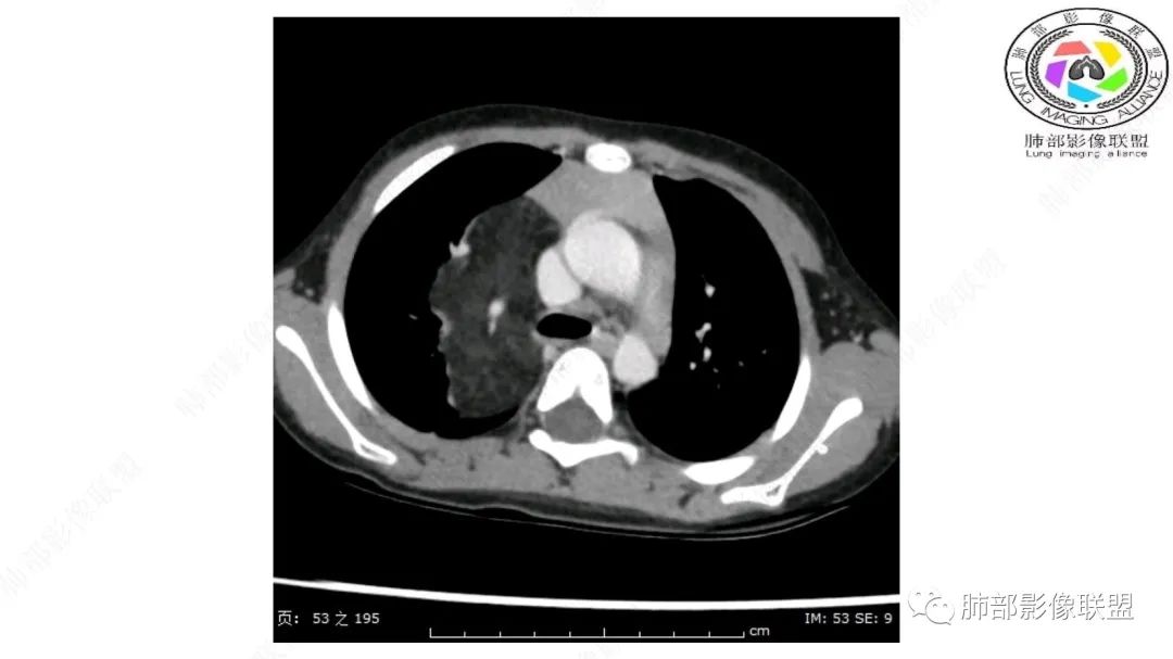 【病例】幼儿脂肪母细胞瘤1例CT影像-20