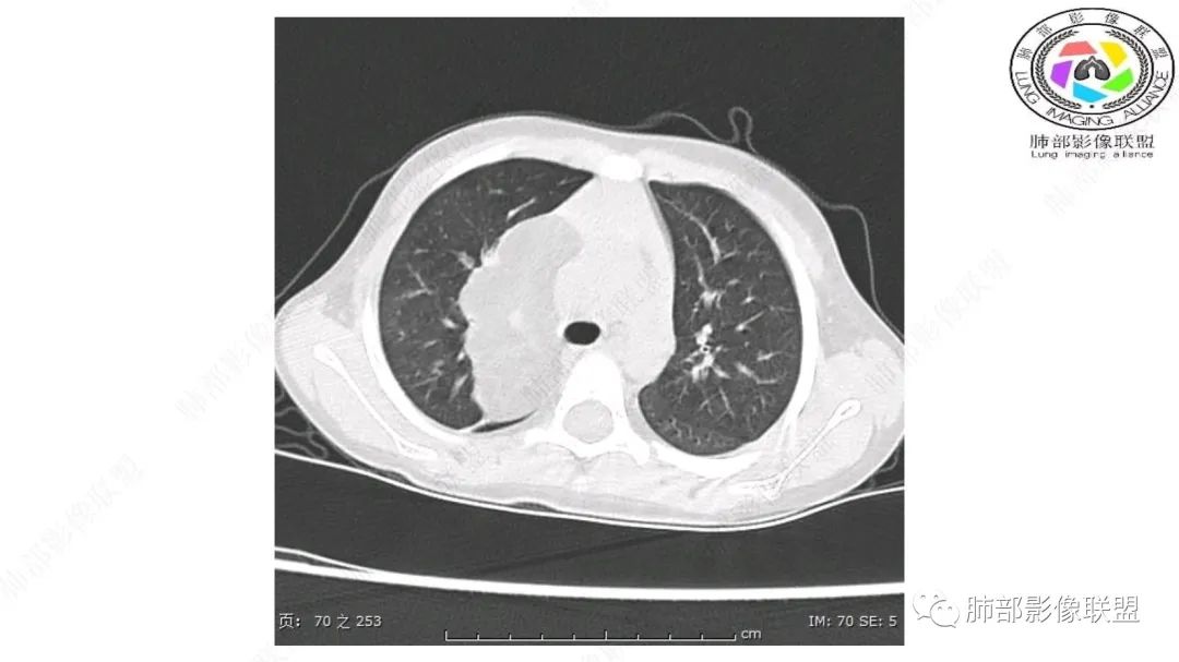 【病例】幼儿脂肪母细胞瘤1例CT影像-21