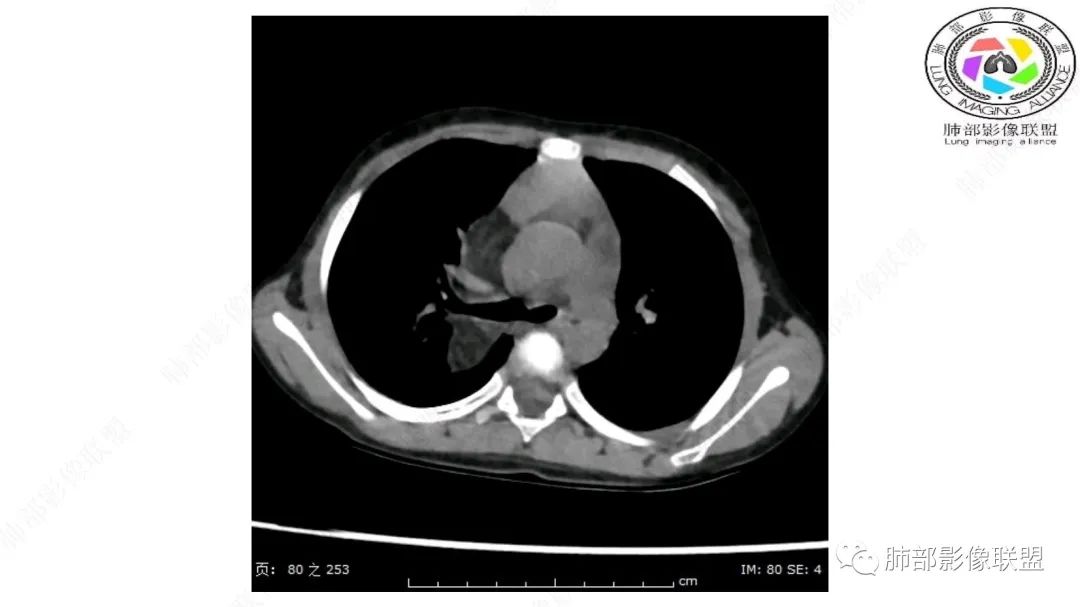 【病例】幼儿脂肪母细胞瘤1例CT影像-22