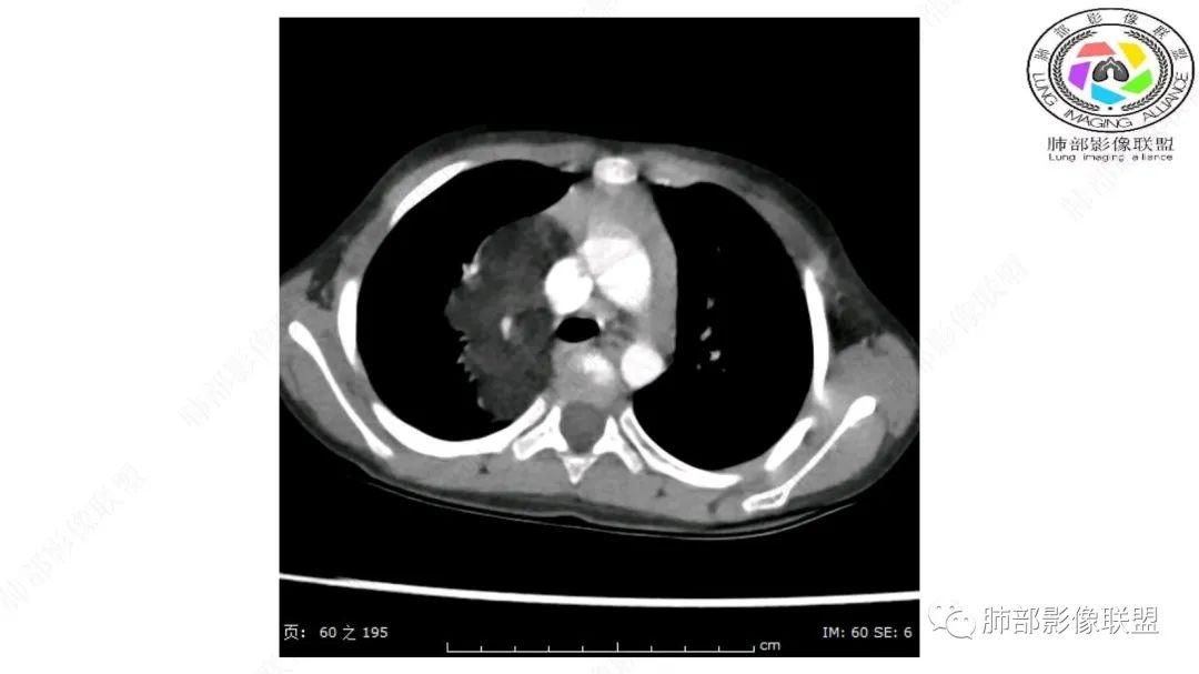 【病例】幼儿脂肪母细胞瘤1例CT影像-23