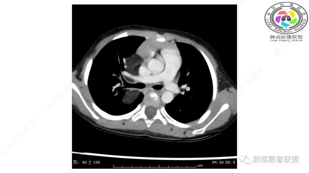 【病例】幼儿脂肪母细胞瘤1例CT影像-24