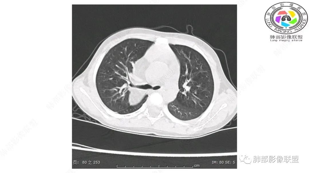 【病例】幼儿脂肪母细胞瘤1例CT影像-25