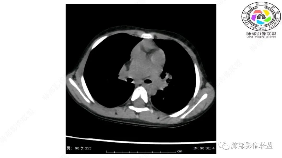 【病例】幼儿脂肪母细胞瘤1例CT影像-26